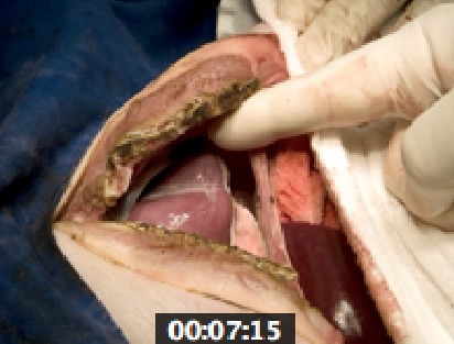 Figure 1. In vivo porcine median Sternotomy@120w, 5 lts/min