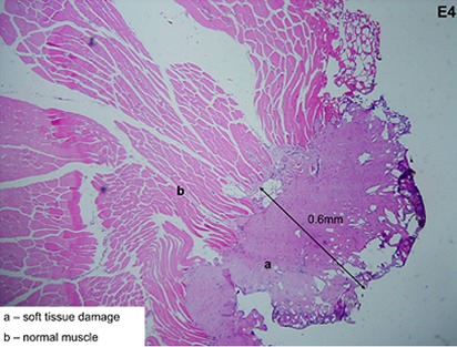 Figure 2. In vivo porcine resection of sternum: depth of injury 0.6mm, 120w@ 5 liters/min